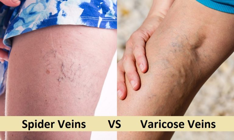 Spider and Varicose Veins Treatment