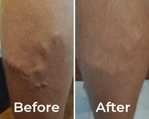 veins clinic brisbane