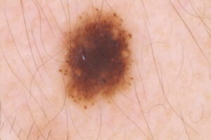 possible skin cancer